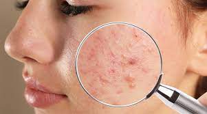 Solve Acne Problems